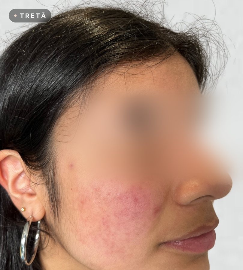Active acne after treatment at TRETĀ Derma