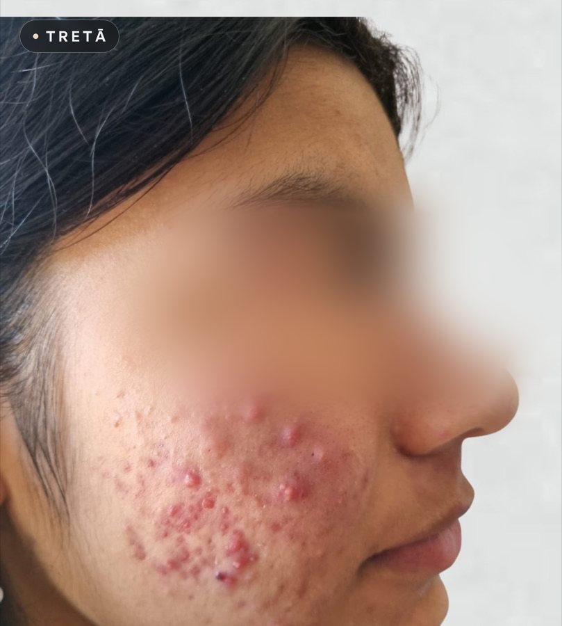 Active acne before treatment