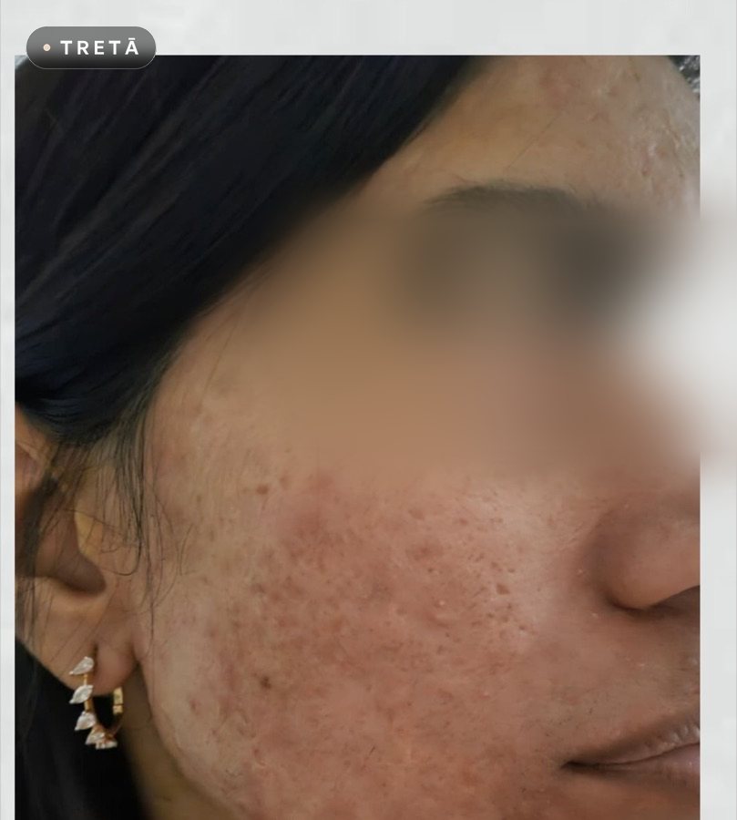 Acne scars after treatment at TRETĀ Derma