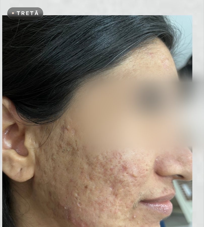 Acne scars before treatment