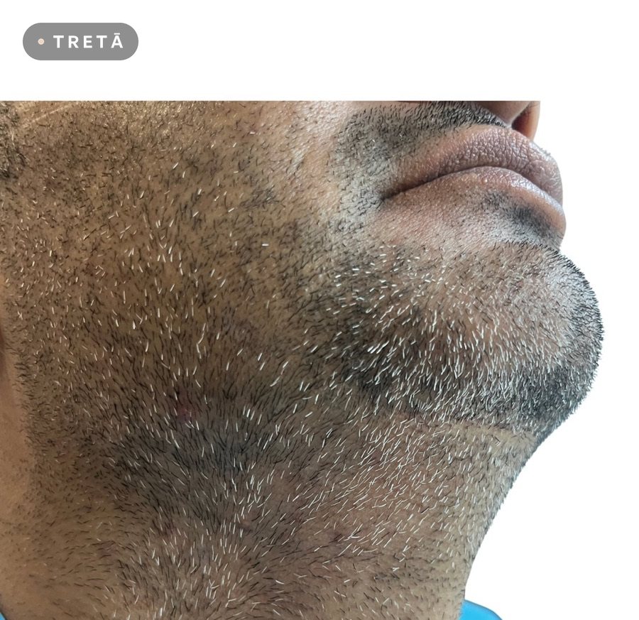 Alopecia areata after treatment at TRETĀ Derma