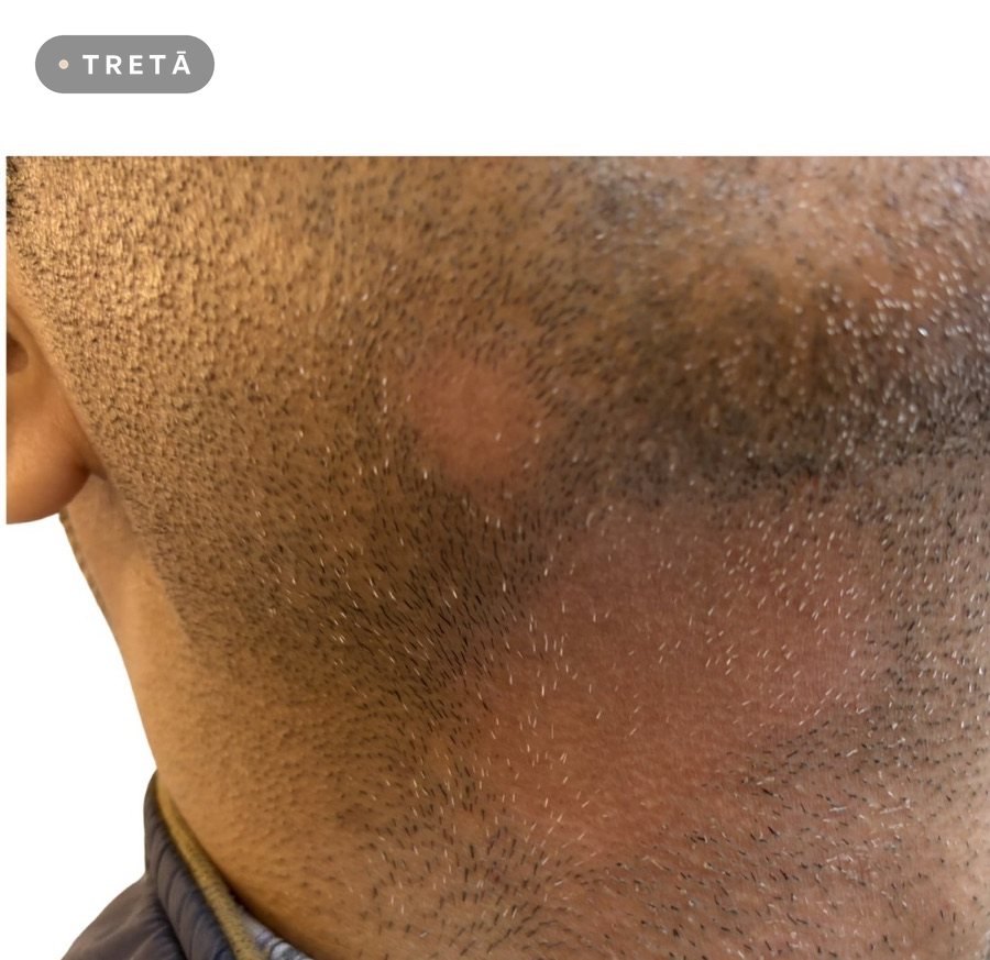 Alopecia areata before treatment