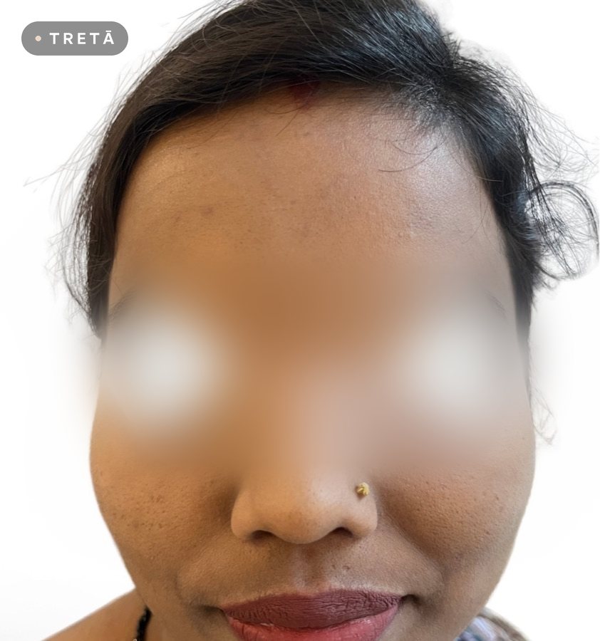 Chemical peel after treatment at TRETĀ Derma