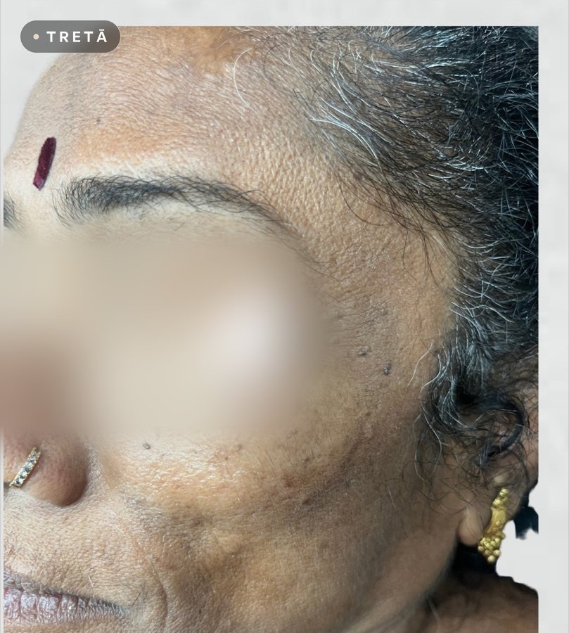Dermatosis papulosa nigra before treatment