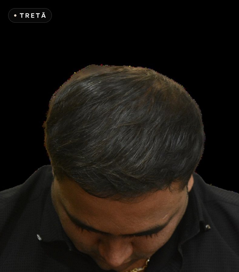 Hair transplant, crown after treatment at TRETĀ Derma