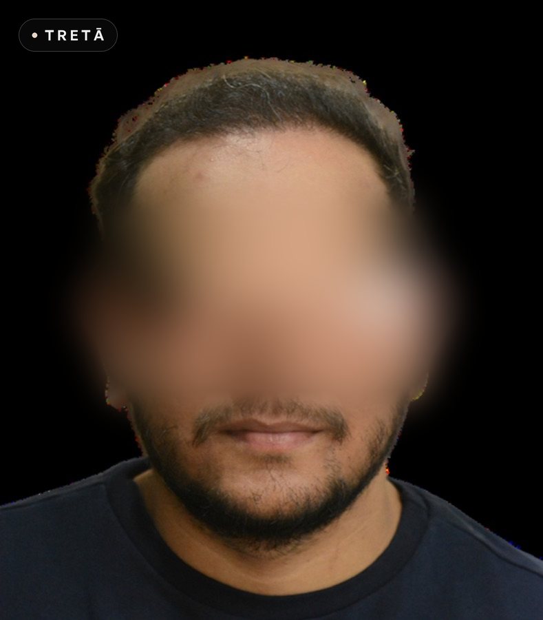 Hair transplant, density after treatment at TRETĀ Derma