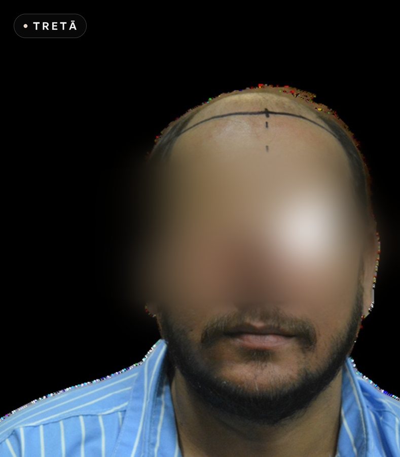 Hair transplant, density before treatment