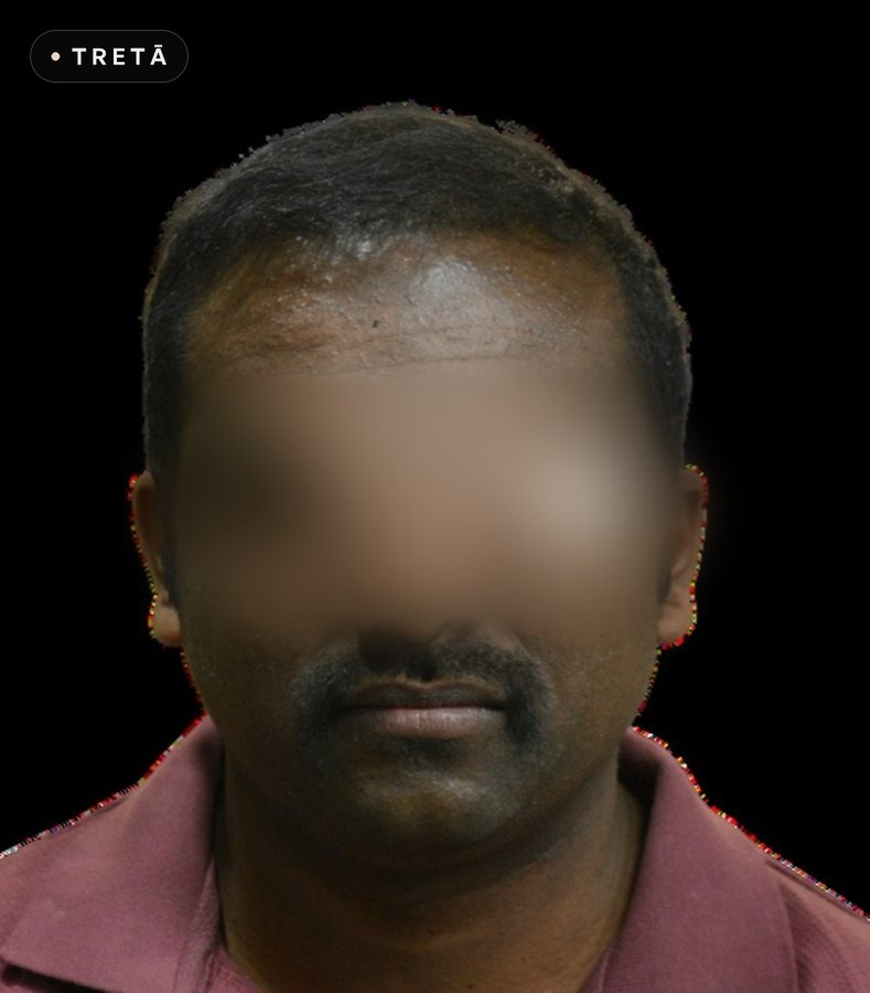 Hair transplant, full front after treatment at TRETĀ Derma