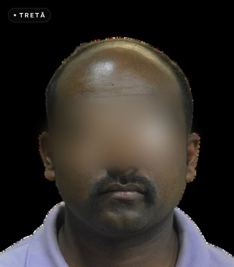 Hair transplant, full front before treatment
