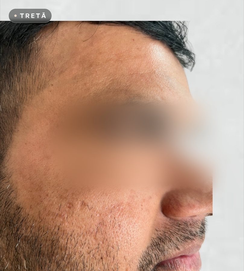 Melasma and pigmentation after treatment at TRETĀ Derma