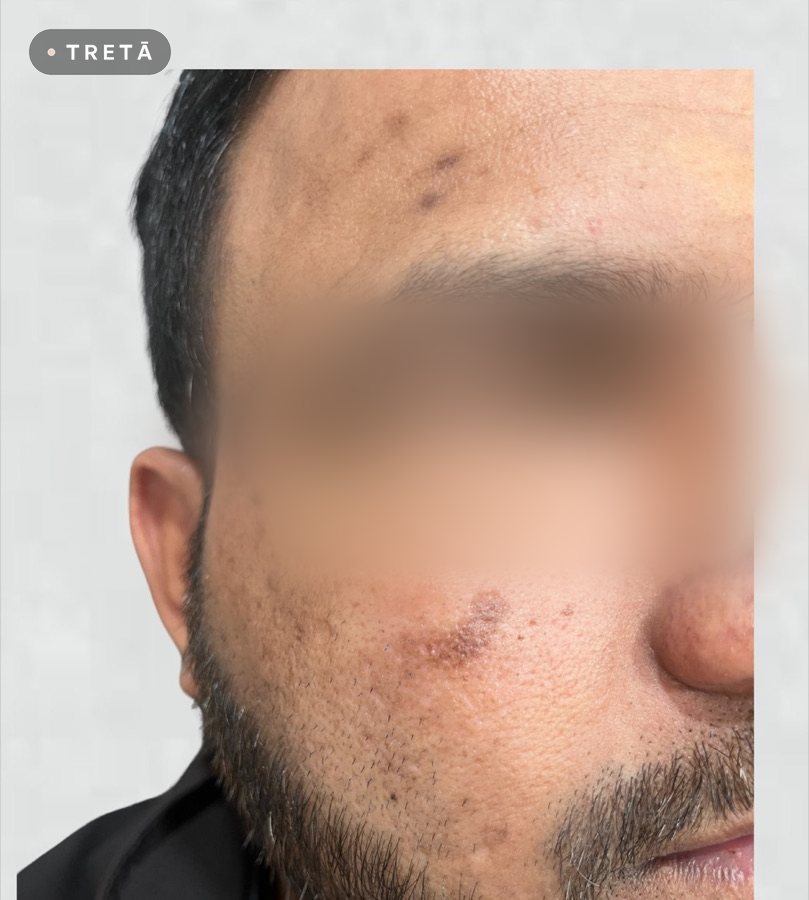 Melasma and pigmentation before treatment